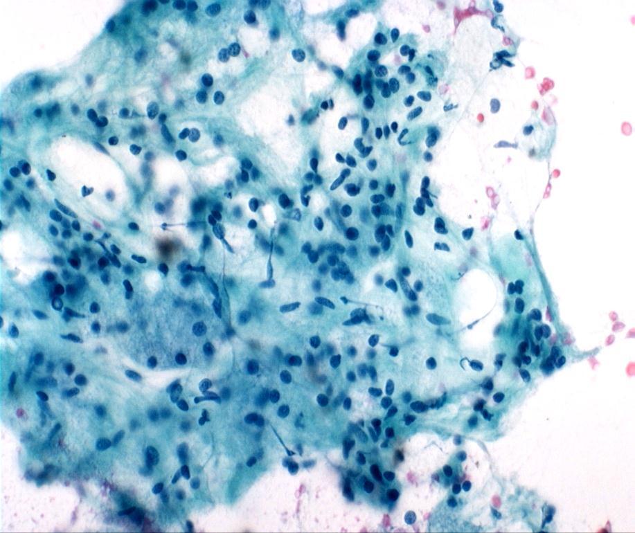 Normal Salivary Gland: Cytology Myoepithelial cells Rare spindled Scant