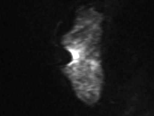 Antero-posterior distance of mammary gland was slightly shorter than T2WI (white arrow). (C) Sagittal DW-MRI using SS-EPI (b=0 s/mm 2 ).