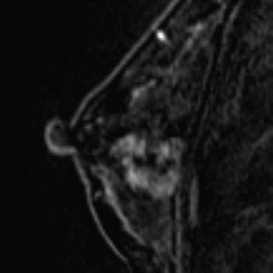 High-resolution diffusion-weighted MRI of the breast using readout-segmented EPI and single-shot EPI RESEARCH PAPER A B C D Figure 3.