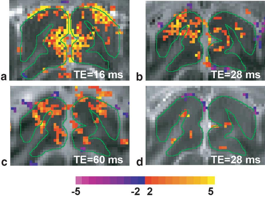 ADC Changes in SE fmri 1289 FIG. 4. Functional ADC t-maps.