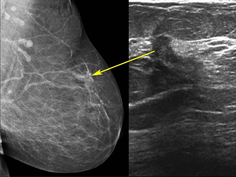 Describe the structure and outcomes of an organized high-risk breast screening program Identify and recommend different breast MRI protocols that can be utilized in routine practice Describe the