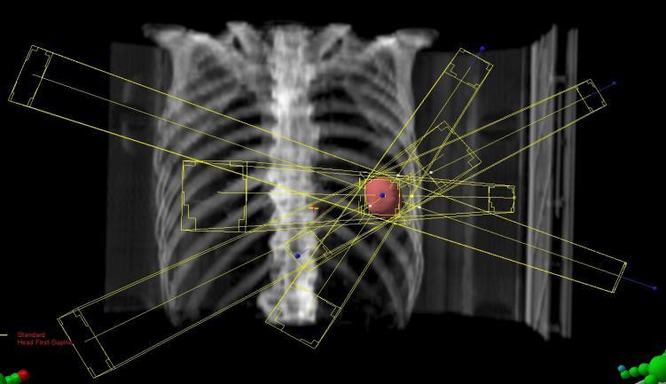 Stereotactic body radiation therapy (SBRT) delivers very targeted beams of radiation to a small area over a few days SBRT is less invasive than surgery SBRT is