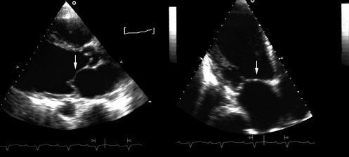 performing emergency echocardiography in the case of acute myocardial infarction associated with cardiogenic shock or pulmonary oedema, in order to avoid any delay in the management of such patients.