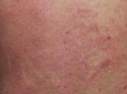 scratch marks Eczema -