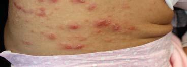 contact or infected objects Clues: Pruritus, hx of possible exposure