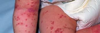 Case 6 Eczema herpeticum Herpes simplex 1 or 2