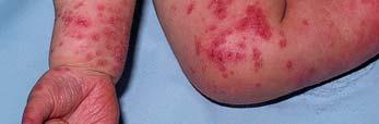 and vesicles within eczema lesions May have fever,