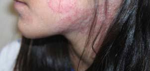pustules; tinea incognito: steroid can take away scale