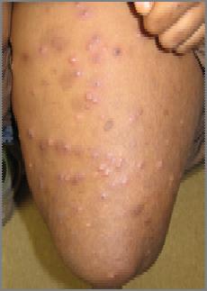 Epidermolysis bullosa Case 11 Molluscum contagiosum Poxvirus infection of the epidermis May become