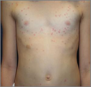 in patients with eczema) imiquimod 5% cream oral