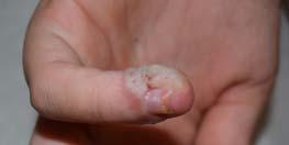 Warts Human papilloma virus Highest incidence in 10 19 y/o 65% disappear in 2 years when immune system sees warts, some may take longer to go