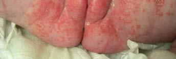 candida albicans May start as irritant diaper dermatitis