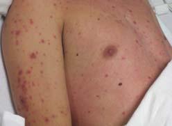 renal failure Caused by exfoliative toxin by Staph