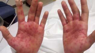 infection Treatment: pain control, local wound care,