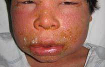 Allergic: delayed type hypersensitivity reaction, ex.