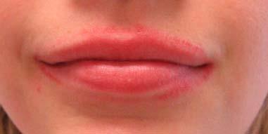 Lip licker s dermatitis (irritant