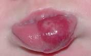 disfigurement (glabella, lip, nose, ears) Size/growth potential Ulceration risk Segmental.