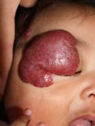 obstruction, chronic conjunctivitis Nasal tip distortion of nasal anatomy and residual Cyrano deformity Lips