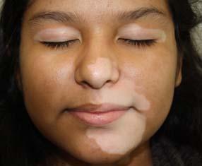 Treatment: topical steroids, TCIs or excimer