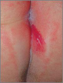 complication 10% of lesions during proliferative phase Most common in intertriginous sites,