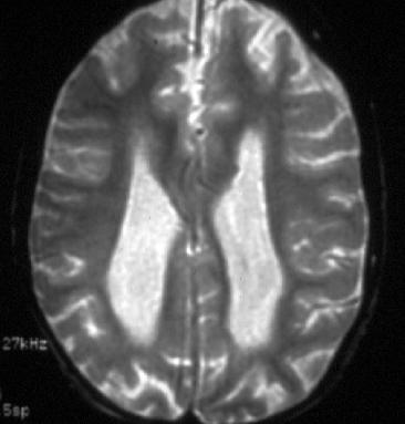 4 year old girl presenting in 1992 with: -static cognitive delay -lactic acidosis -seizures -hemiplegic migraine MRI shows disorder of neuronal migration complex I defect