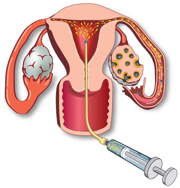 Intrauterine Insemination Procedure in which washed and concentrated motile sperm is placed directly into the uterine cavity, just prior to ovulation Useful for couples with sexual dysfunction,