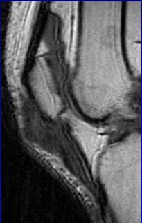 tendon: knee