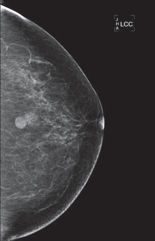 Eccrine Spiradenoma in Breast Simulating Epidermal Inclusion Cyst was recommended that the patient undergo routine followup.