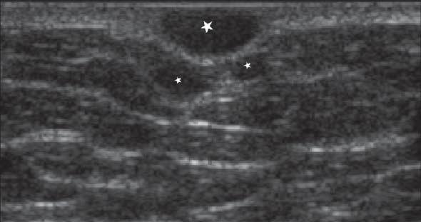 A breast MRI exam using a dedicated bilateral breast coil showed low signal intensity on the T1-weighted images, low- to intermediate-signal intensity on the T2-wighted turbo spin echo images, high
