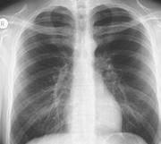 Lung cancer Silicosis (thickening and scarring of the lungs) Chronic obstructive pulmonary disease (COPD) Rheumatoid arthritis Tuberculosis THE BURDEN OF LUNG CANCER