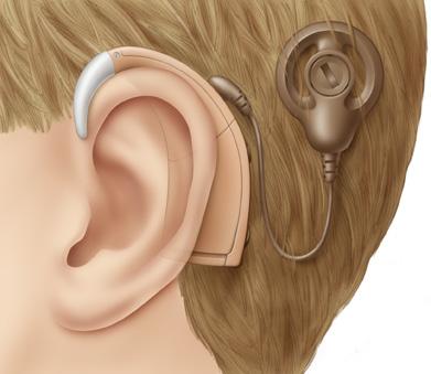 This allows sound to bypass the damaged parts of the ear.