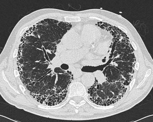 1010 du Bois, King Figure 2 Typical CT scan from a patient with idiopathic pulmonary fibrosis.