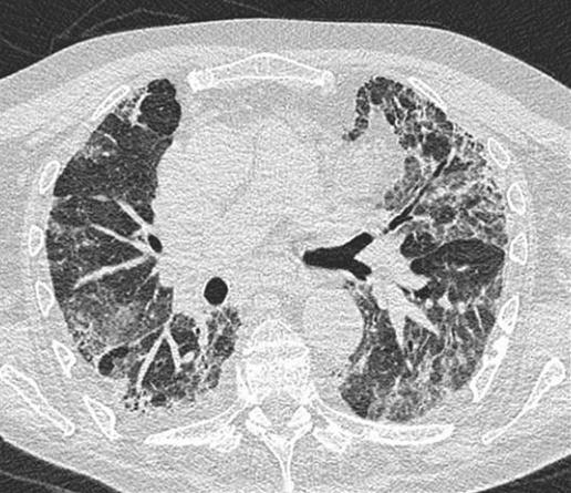 Figure 3 Typical CT scan from a patient with non-specific interstitial. Note the less peripheral distribution of disease than in high.