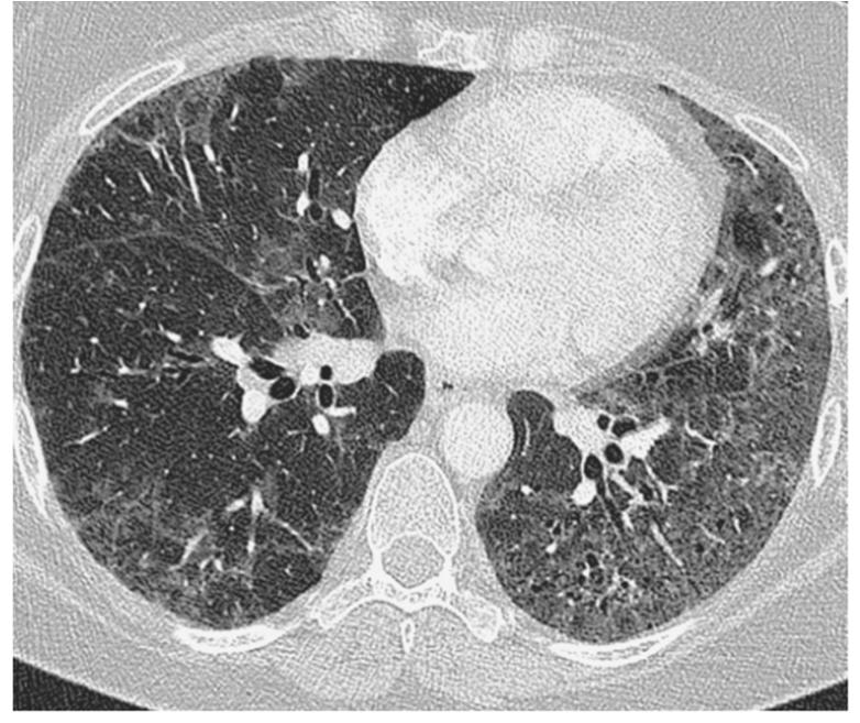 Nonspecific Interstitial Pneumonia 1 1.