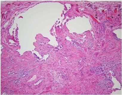 Histologic Tools for Diagnosis 1,2 Histology Bronchoscopy Surgical lung biopsy UIP Pattern Marked fibrosis/architectural distortion