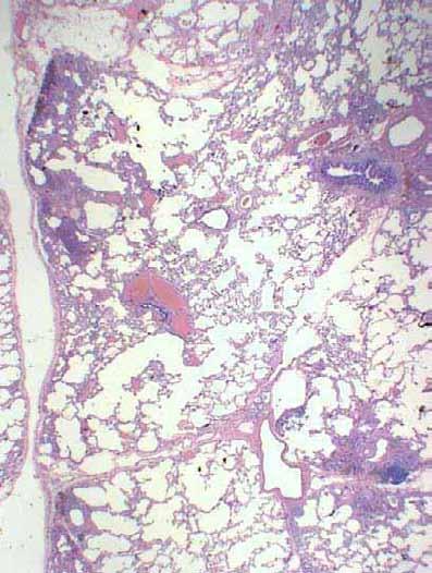 Evidence of active fibrosis as fibroblast foci 3.