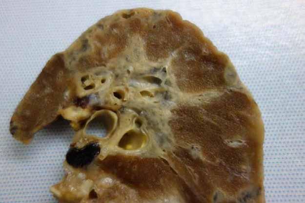 Pleuroparenchymal fibroelastosis (PPFE): gross from an explant Sometime other ILD