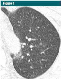 Interstitial lung abnormalities (ILA) in a CT lung cancer