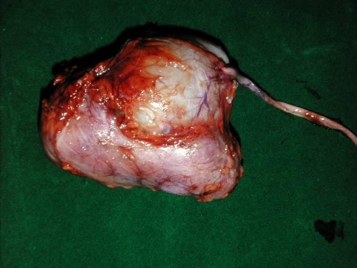 Pelvi-ureteric