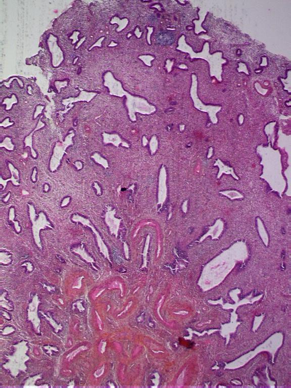 Adenosarcoma differential diagnosis Endometrial polyp no phyllodes or