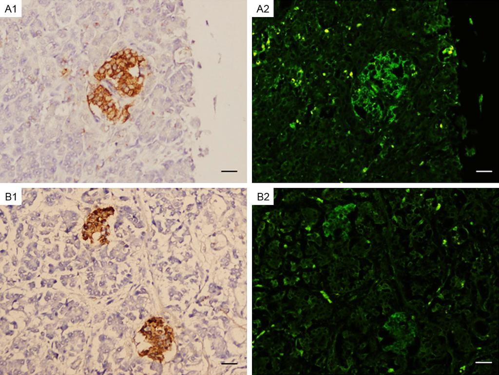 Figure 2. Representive images of IHC and IIF staining on human pancreatic TMA. Rabbit anti-human insulin (No. 1) was used as primary antibody in IHC (A1) and IIF (A2) staining.