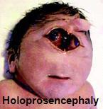 - External hydrocephalus: Excessive accumulation of the CSF between the brain &