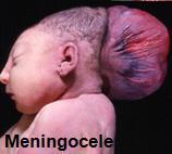 3) Menigocele: the meninges herniated through a deficient part of the skull.