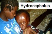 5) Meningo-hydro-enecephalocele: part of the ventricle is found within the brain tissue