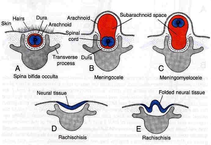 Congenital Malformations of spinal cord development 1) Spina bifida occulta: Absent vertebral arch with normal