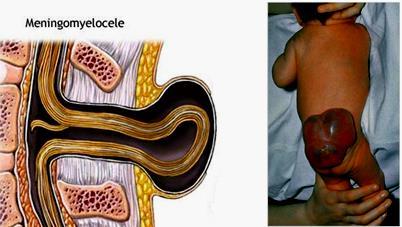 2) Spina bifida cystica: - Meningocele: The meninges herniates through the spina bifida to form subcutaneous sac