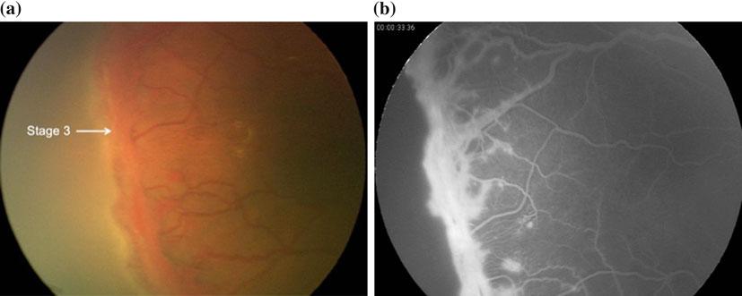 16 T. Lee Fig. 2.4 a Stage 3 present temporally in the right eye (white arrow). b Fluorescein Angiography showing stage 3 at the edge of the vascularized retina even detachment.