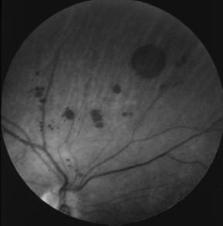 CHRPE Posterior Segment Disease: Case Challenges Steven Ferrucci, OD, FAAO Chief, Optometry Sepulveda VA Professor, SCCO/MBKU! Lesions are almost always stable in size, but color may change.
