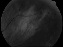 Can also appear as multifocal CHRPE From 3 to 30 lesions, 0.1 to 3.0 mm in size! Benign, stationary and unilateral in 85% of the cases! Often called bear tracks Gardner s Syndrome!