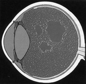 Symptomatic PVD without retinal break AOA:1-2 weeks AAO: depending on symptoms, risk factors and clinical finings:! 1-6 weeks!